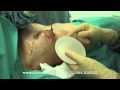 大胸筋下バッグ挿入法による豊胸手術の臨床動画